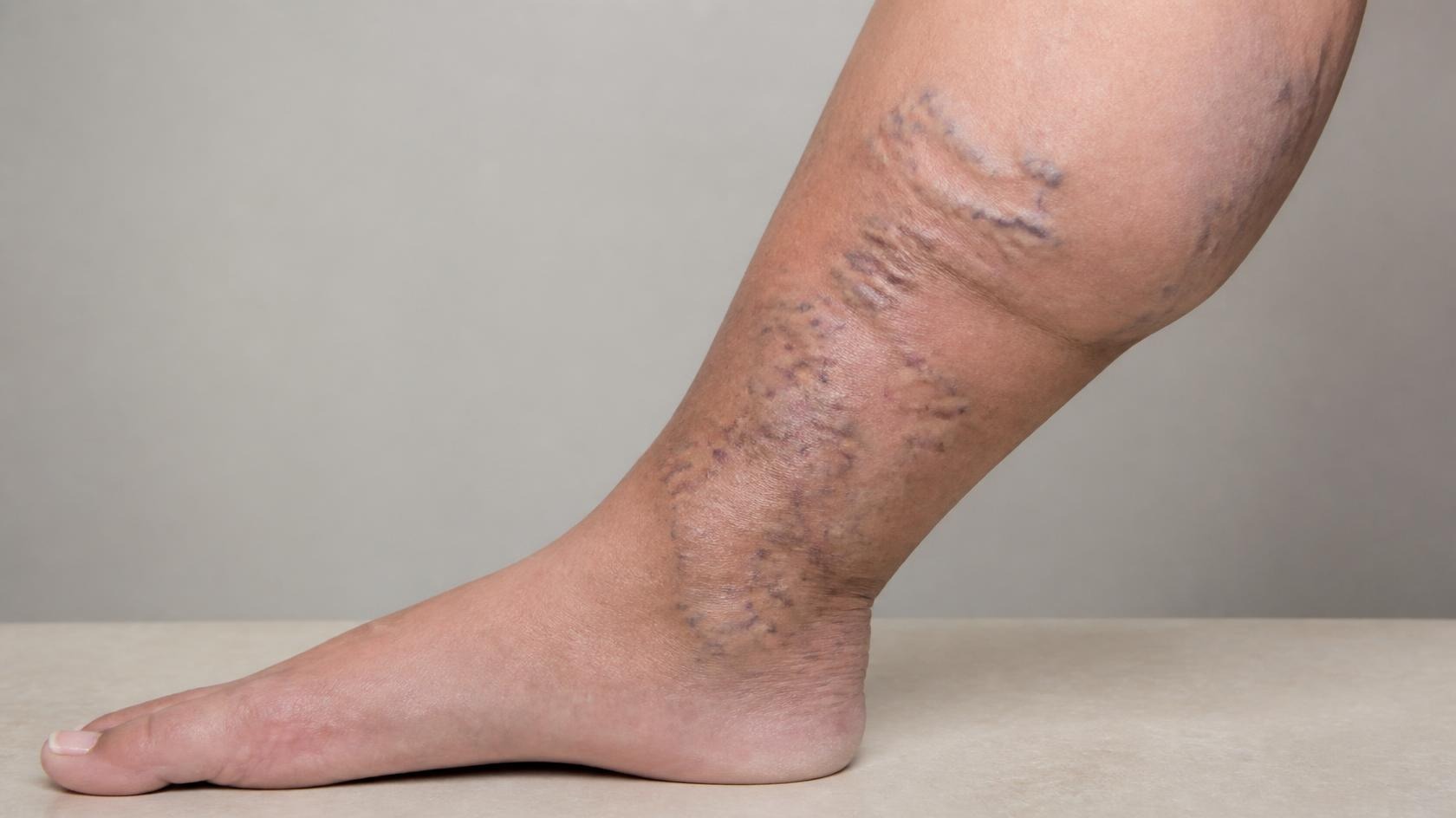 Varicose veins के कारण पैरों में उभरी और मुड़ी हुई नीली नसों का चित्र, साथ में इसके लक्षण, कारण और उपचार की स्वास्थ्य जानकारी।